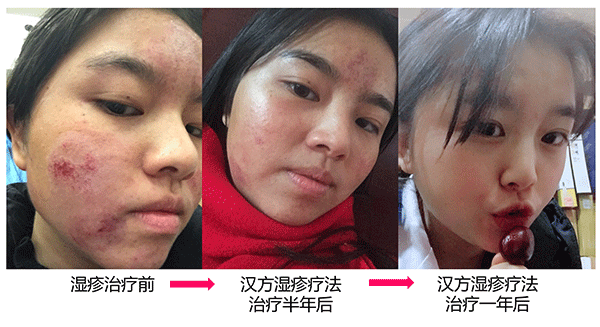 1535679885230865.png 方晶莹汉方湿疹疗法案例.png
