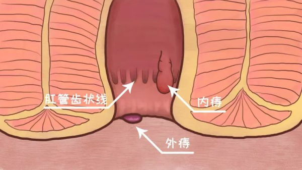 开学季注意合理饮食 内痔保守治疗就用九华痔疮栓
